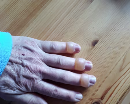 022 Vous n'avez jamais vu de doigts gelés ? En voici trois !