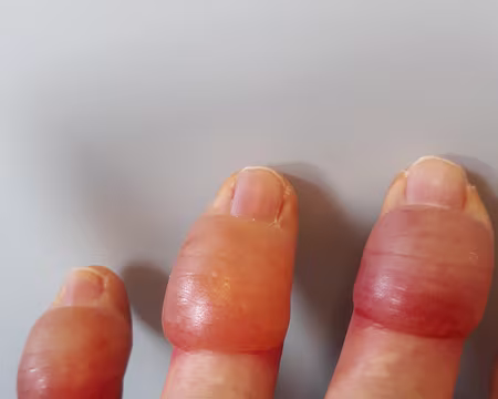 024 Les gelures évoluent...