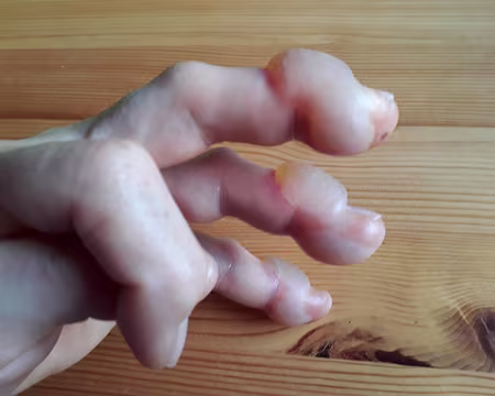 025 Des ampoules se sont formées sur tout le pourtour des doigts. Heueusement, elles auront permis d'éviter l'infection !